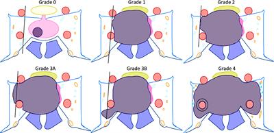 Surgery for acromegaly: Indications and goals